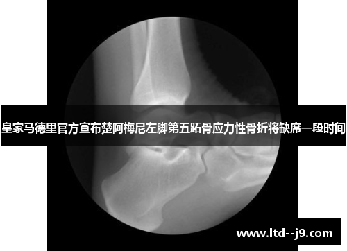 皇家马德里官方宣布楚阿梅尼左脚第五跖骨应力性骨折将缺席一段时间 皇家马德里官方宣布楚阿梅尼左脚第五跖骨应力性骨折将缺席一段时间